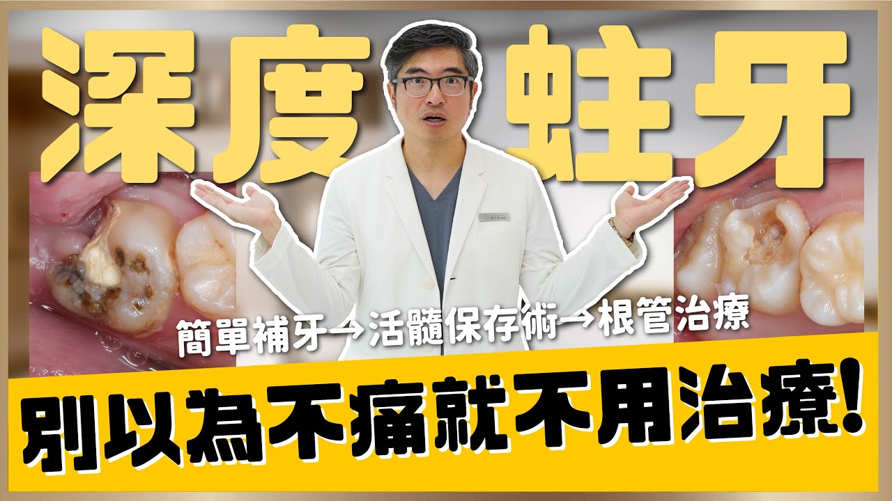【蛀牙 #5】深度蛀牙是什麼？出現深度蛀牙會怎樣？別讓蛀牙的簡單補牙變成根管治療！蛀牙有可能自己好嗎？如何區分蛀牙的嚴重程度？｜【祐民牙醫－隱適美旗艦店】鑽石級楊大為醫師 #蛀牙 #根管治療 #補牙
