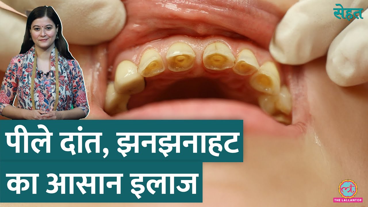 दांतों में झनझनाहट यानी Teeth Sensitivity है? दांतों का रंग बदल रहा है? ये है इलाज | Sehat ep 1024