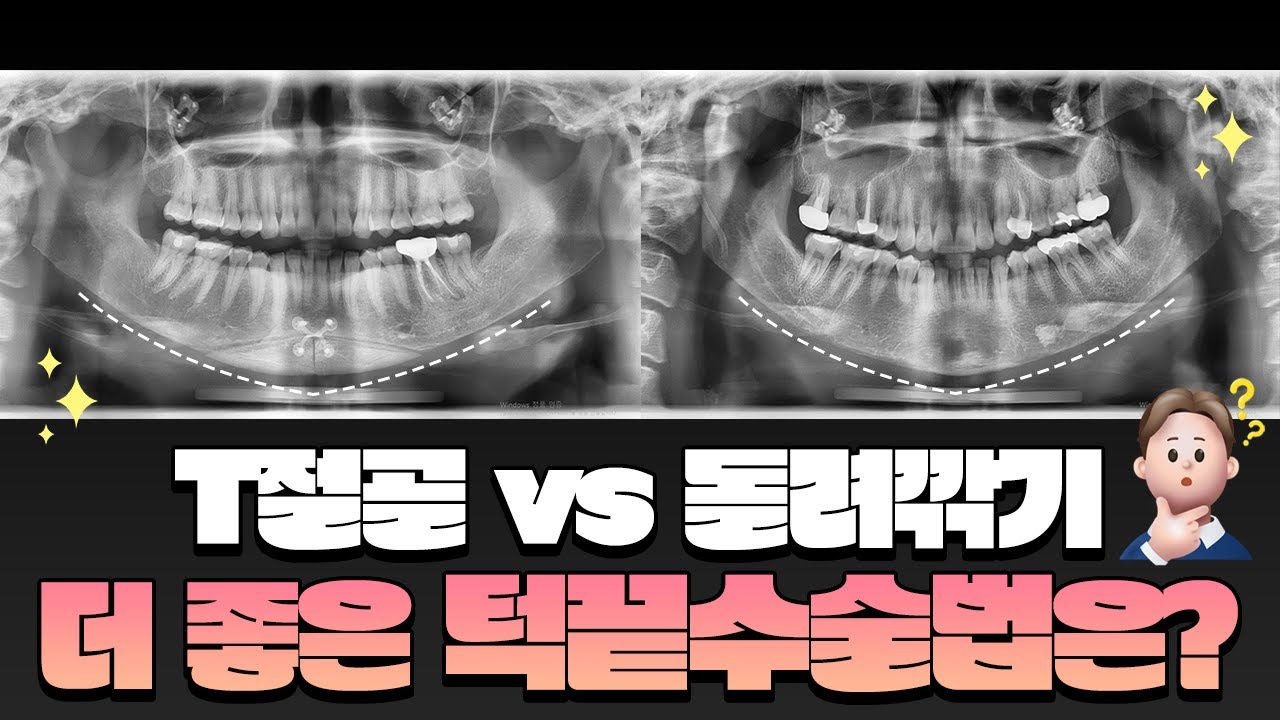 [턱끝수술] T절골 vs 돌려깎기 장단점 비교해보자!