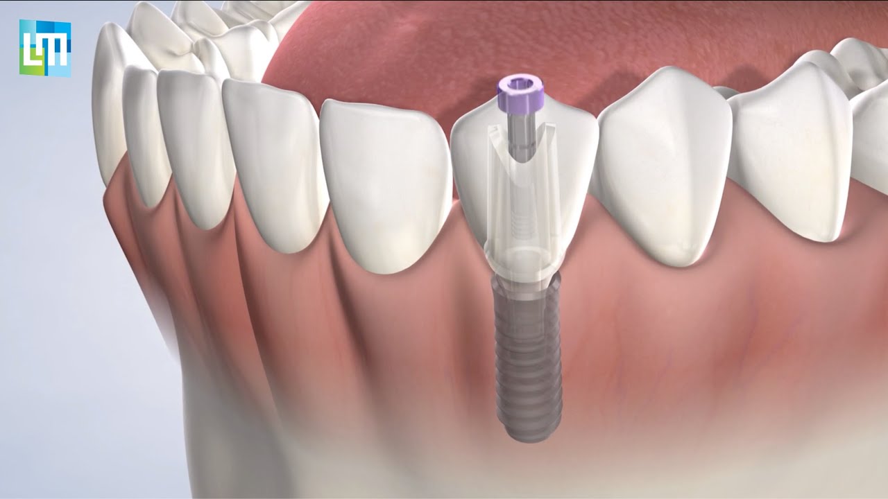 Dental Implants in Crystal Lake IL | Lehman & Menis Dental Implant and Oral Surgery Specialists