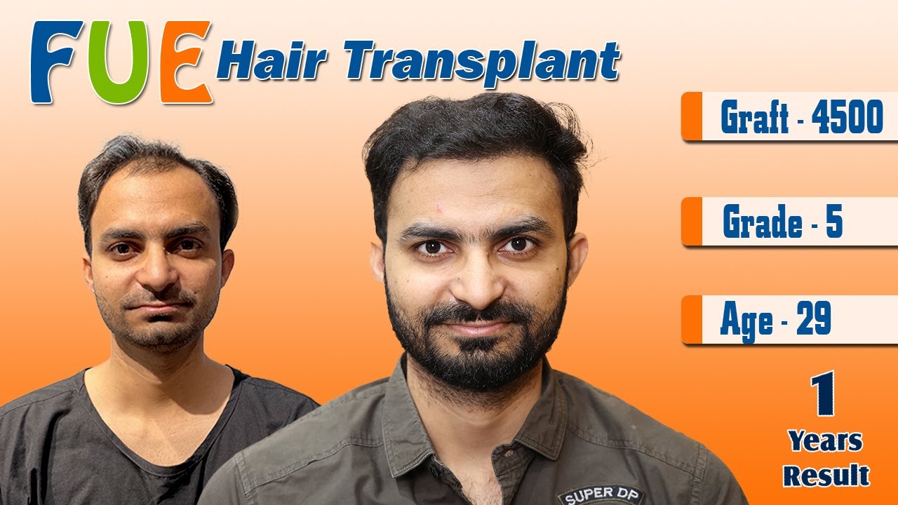 BEFORE & AFTER - Amazing Results After Doctor Vivek Galani Hair Transplant Surgery | RQC.