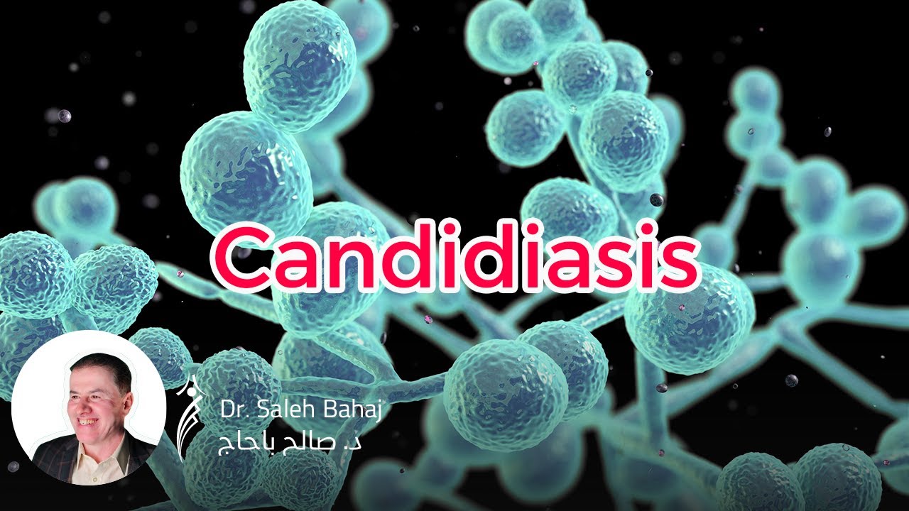 15. Candidiasis