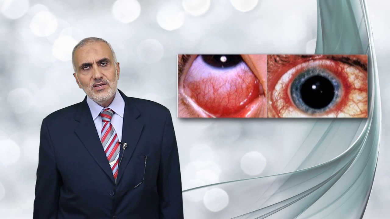 Elbromboly Basic ophthalmology IC Uvea Iridocyclitis