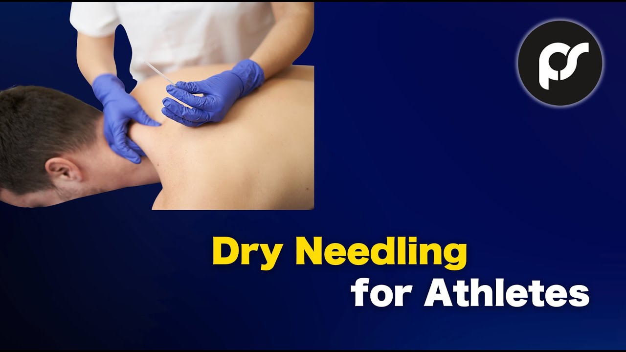 Dry Needling for Athletes: Does It Improve Performance or Recovery? | 5-Minute Science Break