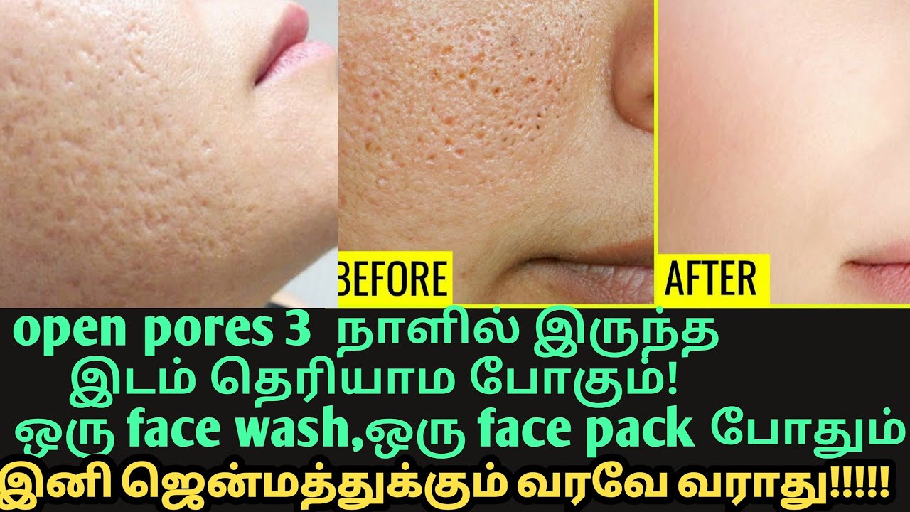 open pores முகத்தின் அழகை கெடுக்குதா!2 pack,3 நாள் போதும்! open pores, large pores remedy Tamil