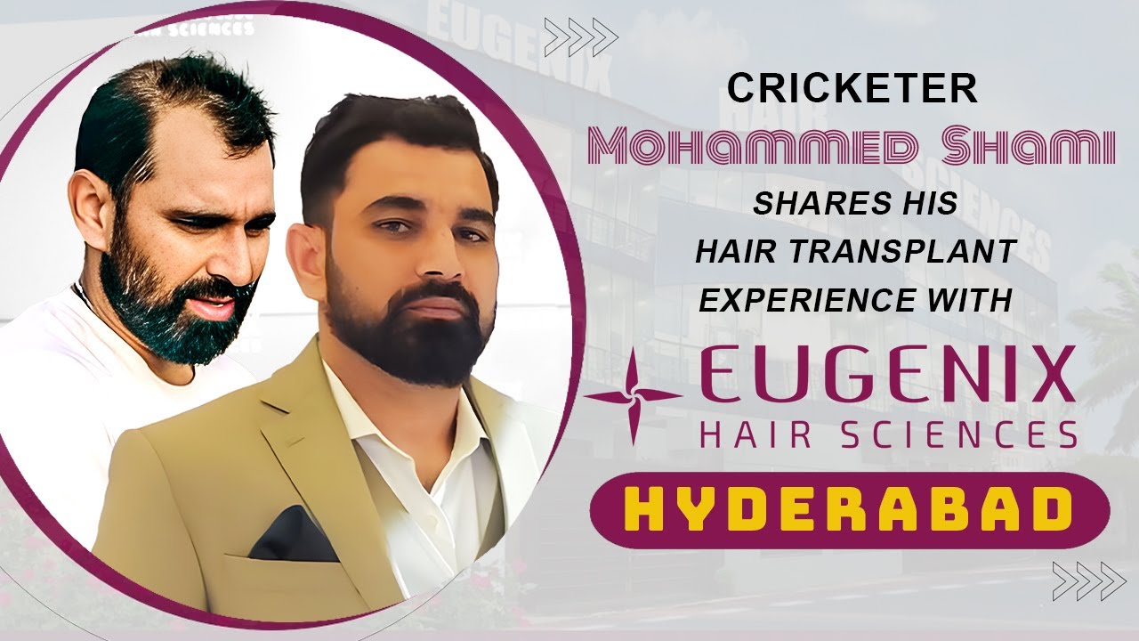 Cricketer Mohd Shami shares his Hair Transplant Experience with Eugenix