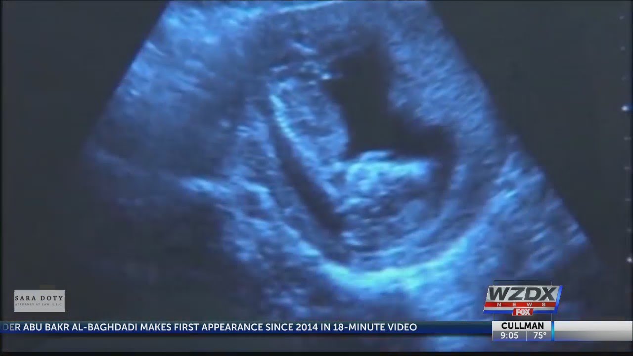 New anti-abortion bill would punish Alabama doctors for performing them