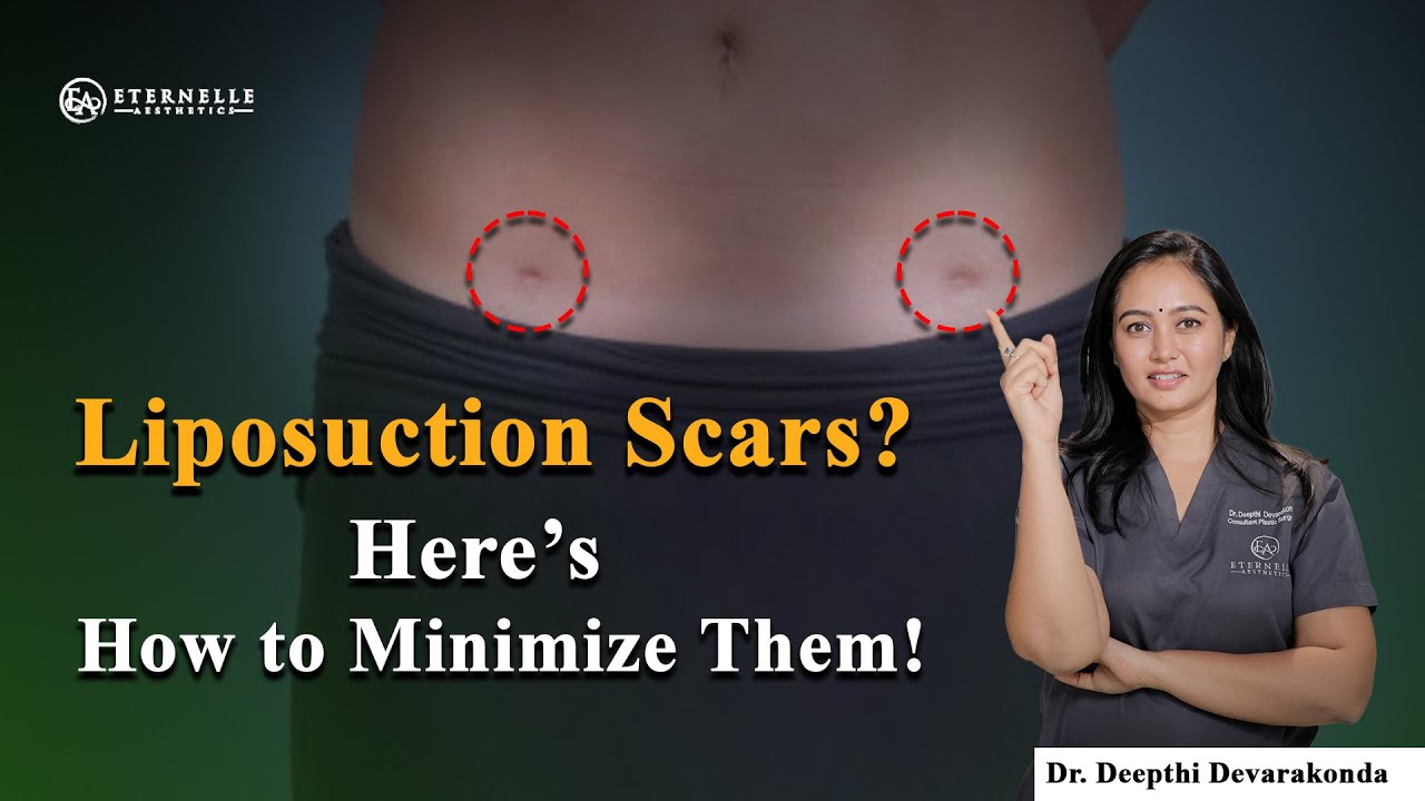 Scars after liposuction | Liposuction treatment | Eternelle Aesthetics in hyderabad
