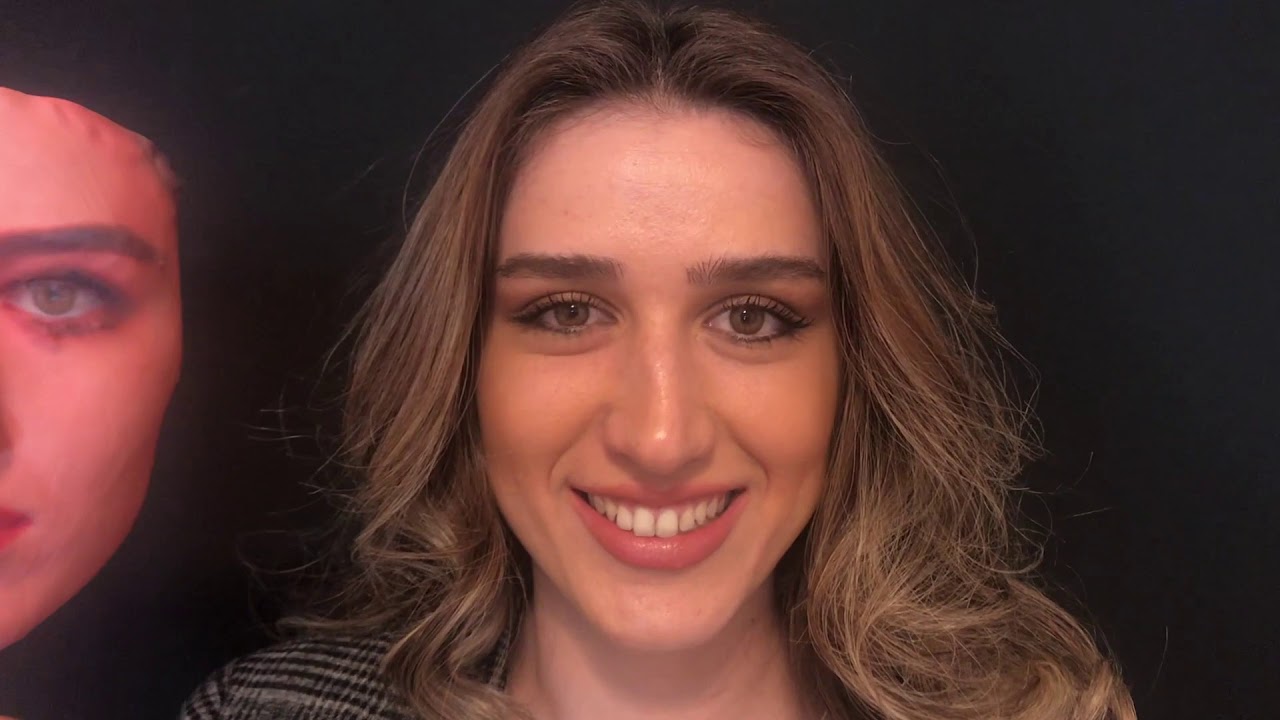 Op. Dr. Ali Murat Akkuş Rhinoplasty Story 1,5 year