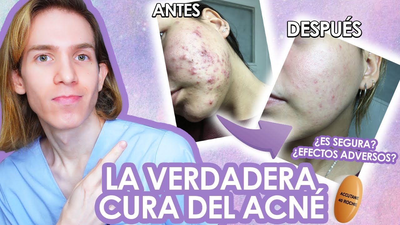 ROACCUTAN o ACCUTANE: Efectos adversos, como tomarla, antes y despues. LA VERDAD de la ISOTRETINOINA