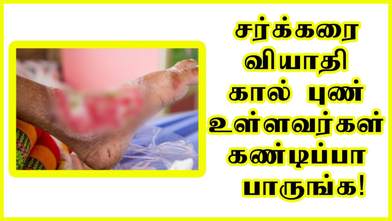 சர்க்கரை வியாதி கால் புண் உள்ளவர்கள் கண்டிப்பா பாருங்க! Diabetic ulcer
