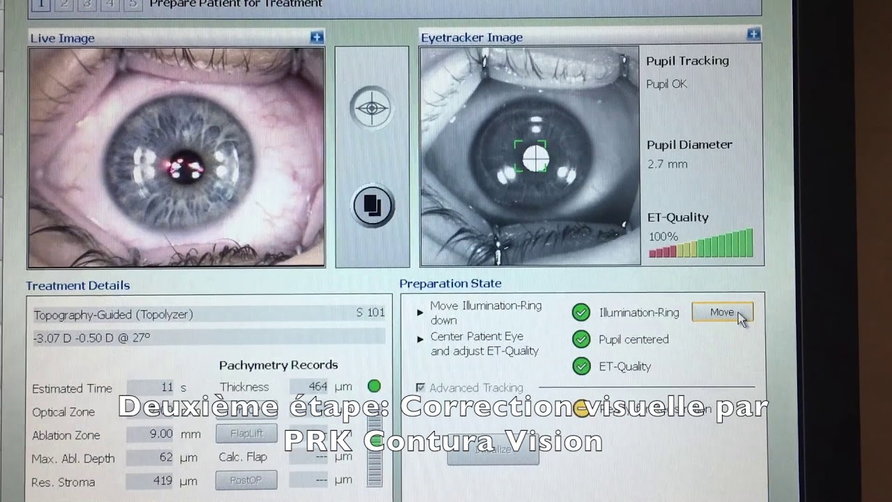 Trans PRK Topoguided Contoura Vision (technique no touch 100% laser)