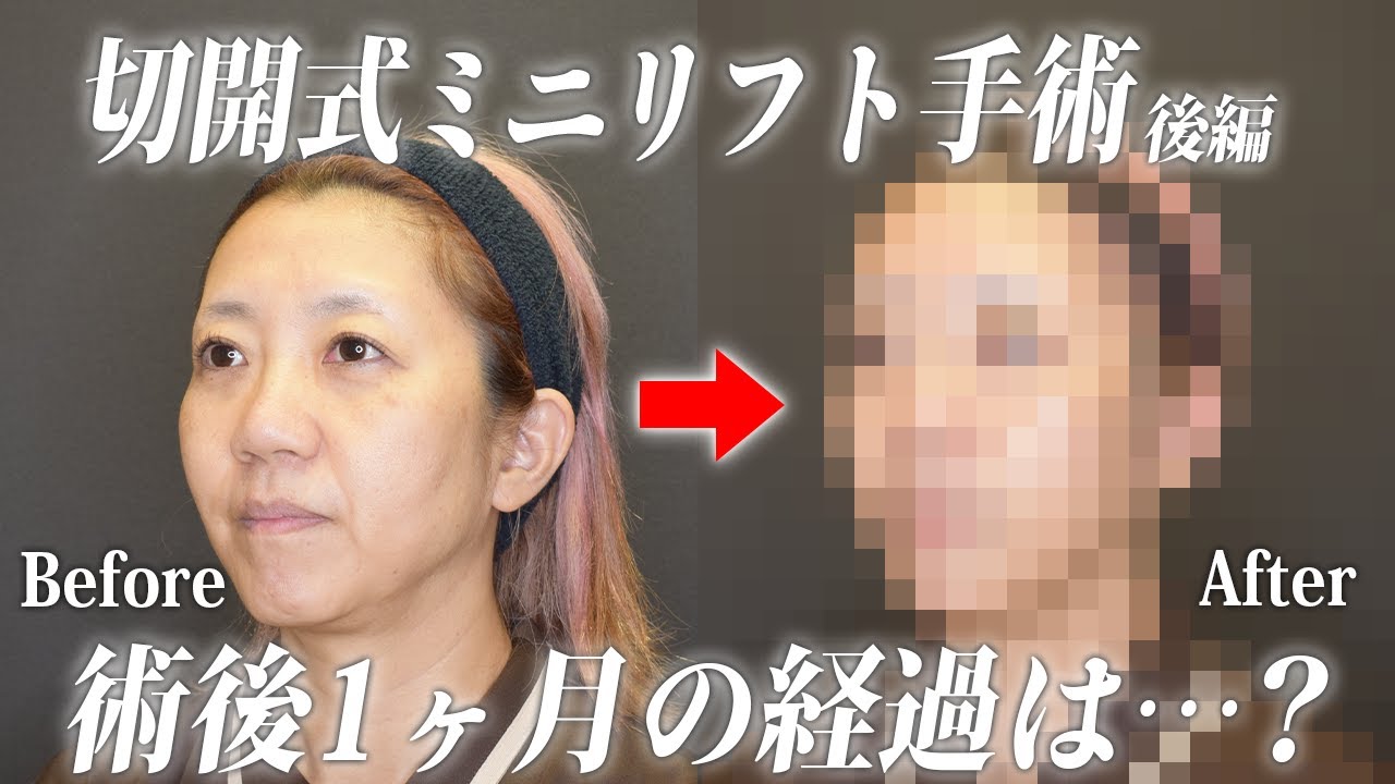 【part2】切開式ミニリフト手術のBefore/After。若々しい口元を手にできたのか？【美容外科の巨匠】