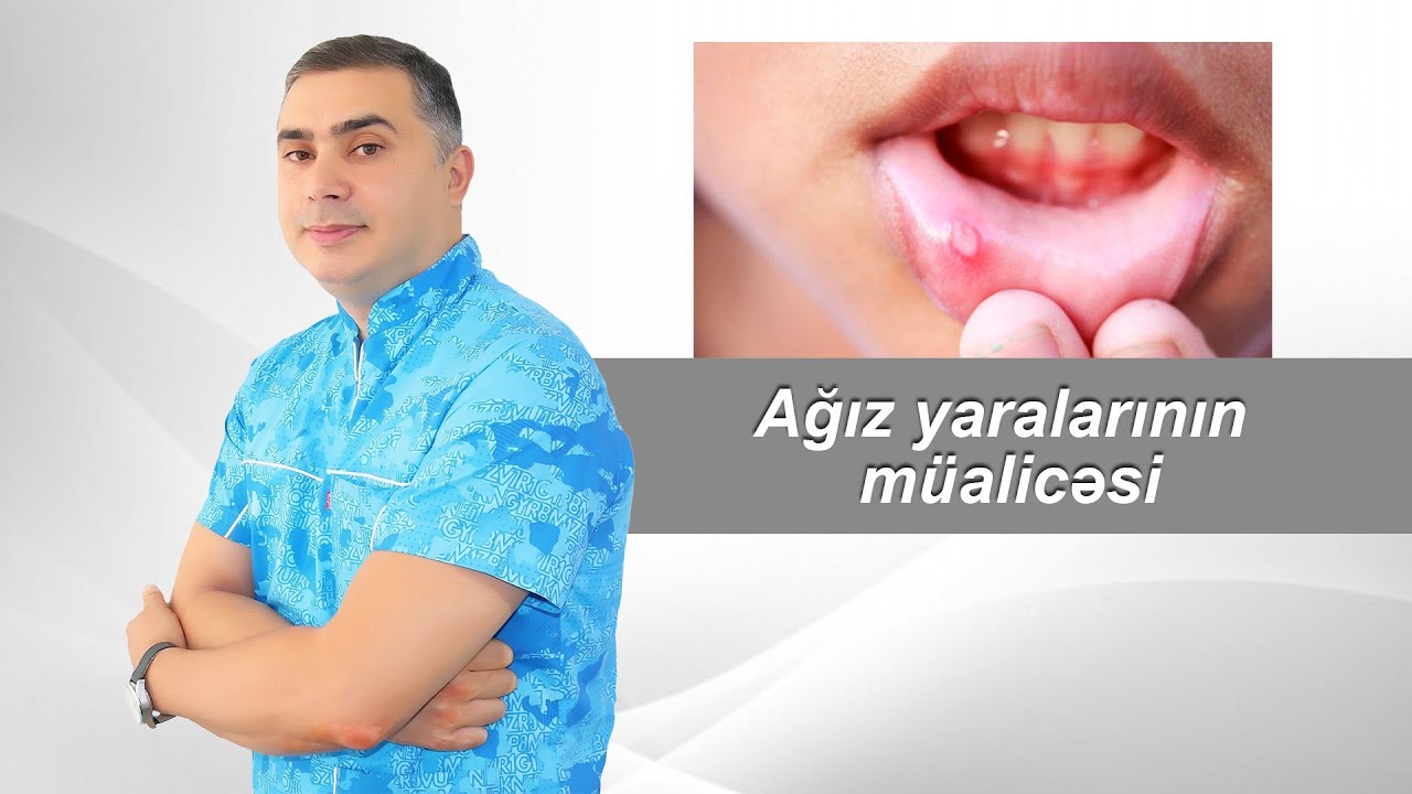 Ağız yaralarının müalicəsi