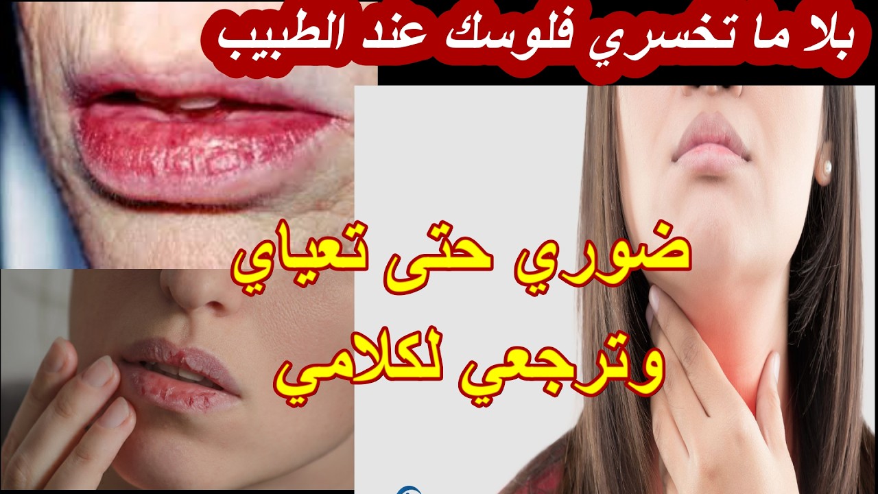 ماهو الحل جفاف الحلق وتقرحات الفم والرائحة الكريهة متحتاجيش تخسري فلوسك عند طبيب