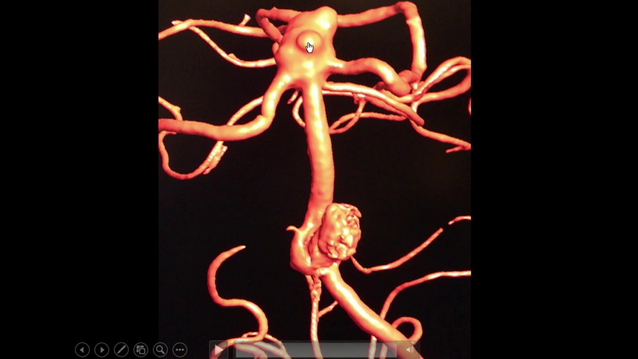Brain Aneurysm Causes
