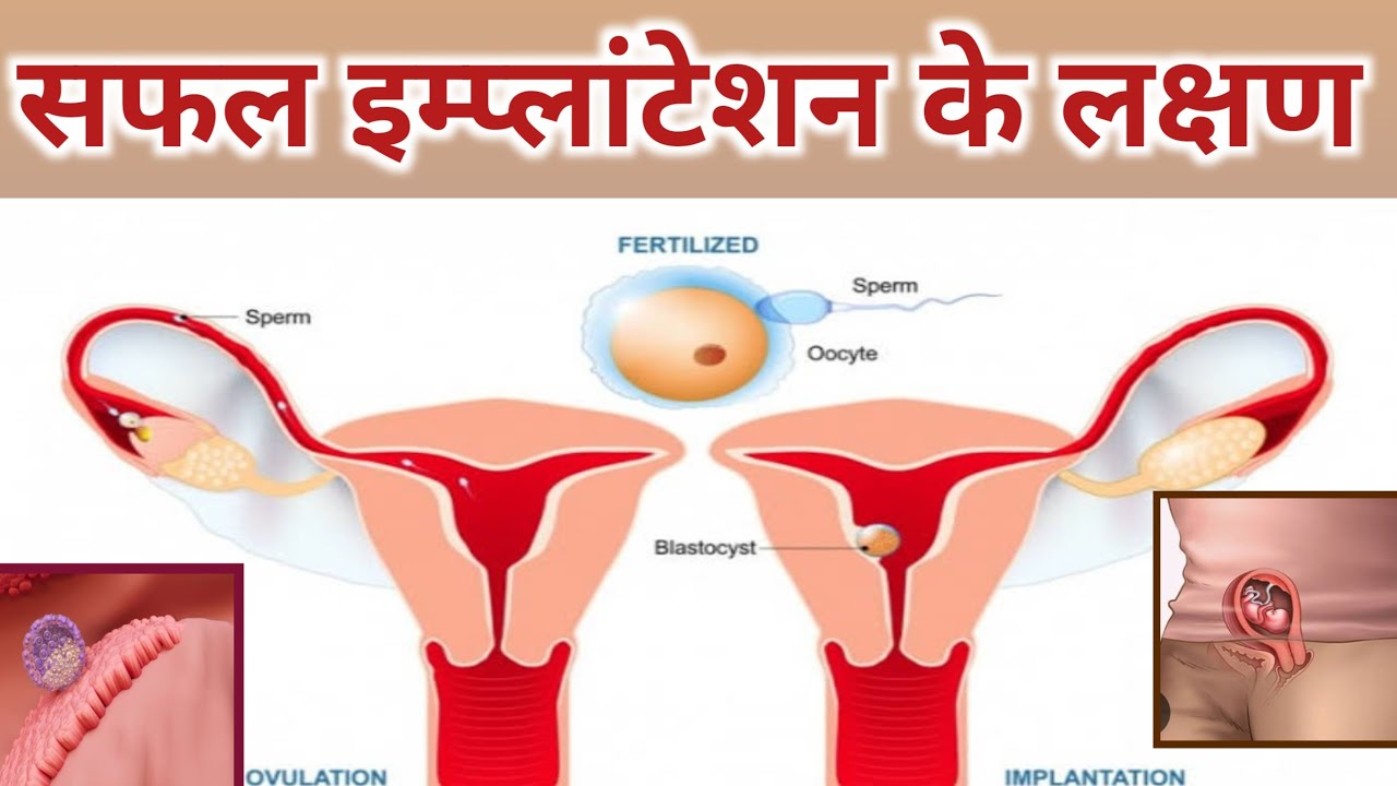 Successful Implantation Symptoms in Hindi ।Early Pregnancy symptoms। Pregnancy Ke Lakshan 