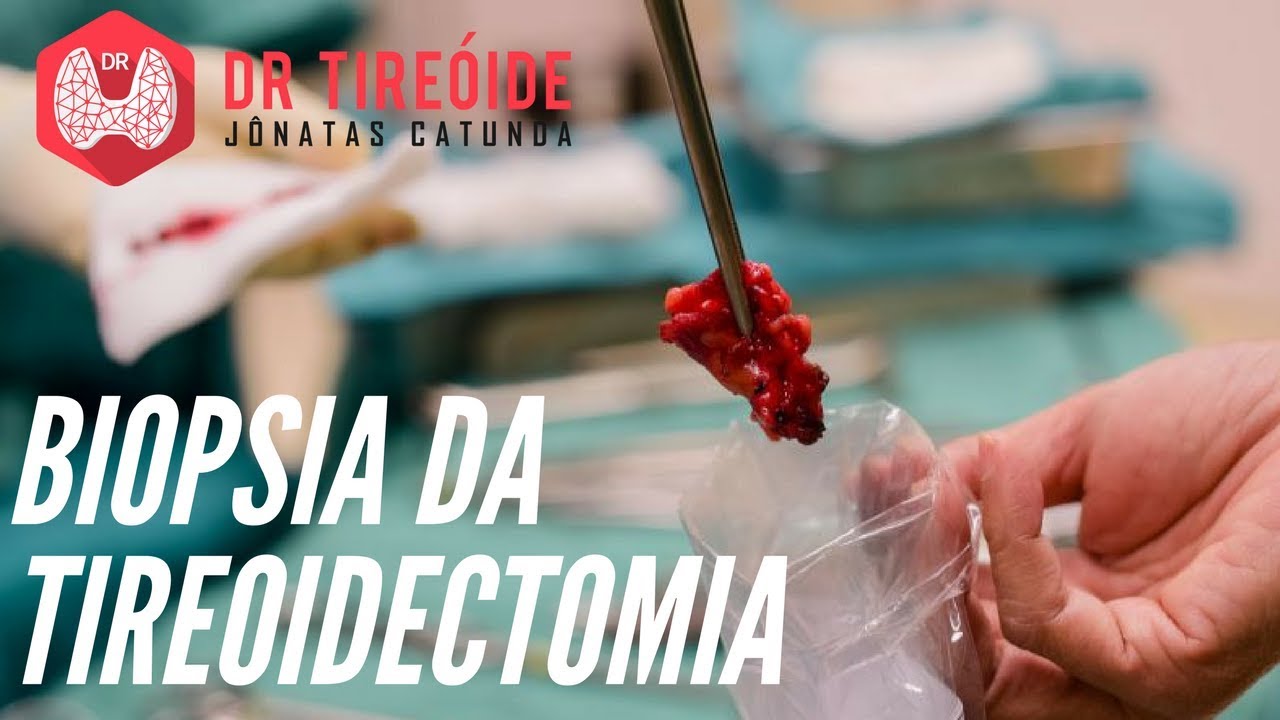 Resultado da bi&oacute;psia da tireoidectomia - Como interpretar?  | Dr J&ocirc;natas Catunda