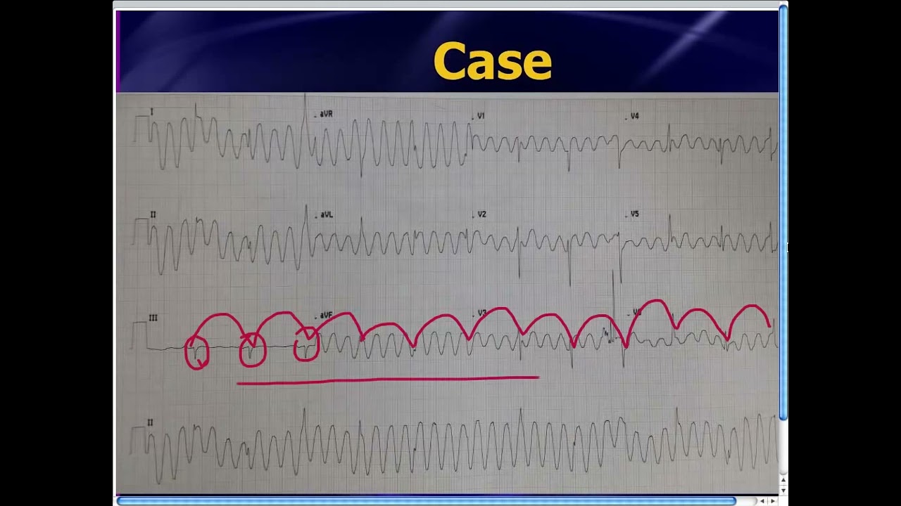 Amal Mattu's ECG Case of the Week_ Sept 22, 2014