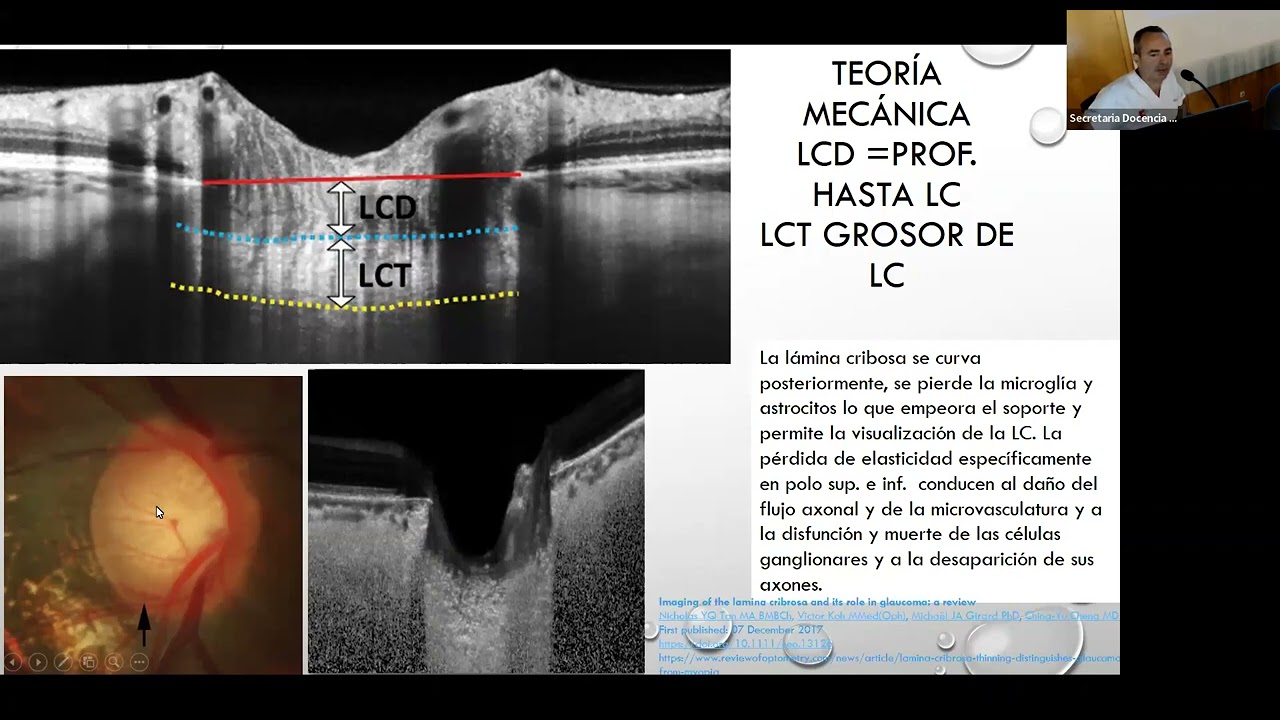 GLAUCOMA, SU DIAGNÓSTICO Y TRATAMIENTO