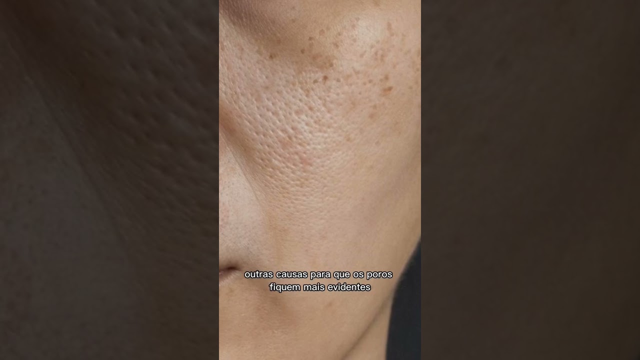 Como diminuir os poros dilatados #pelelinda #pele #pelelimpa #pelesaudavel #saudefeminina #poros