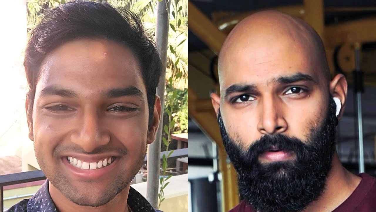 ЛЫСЕНИЕ ИЗМЕНИЛО МОЮ ЖИЗНЬ НАВСЕГДА 🇮🇳