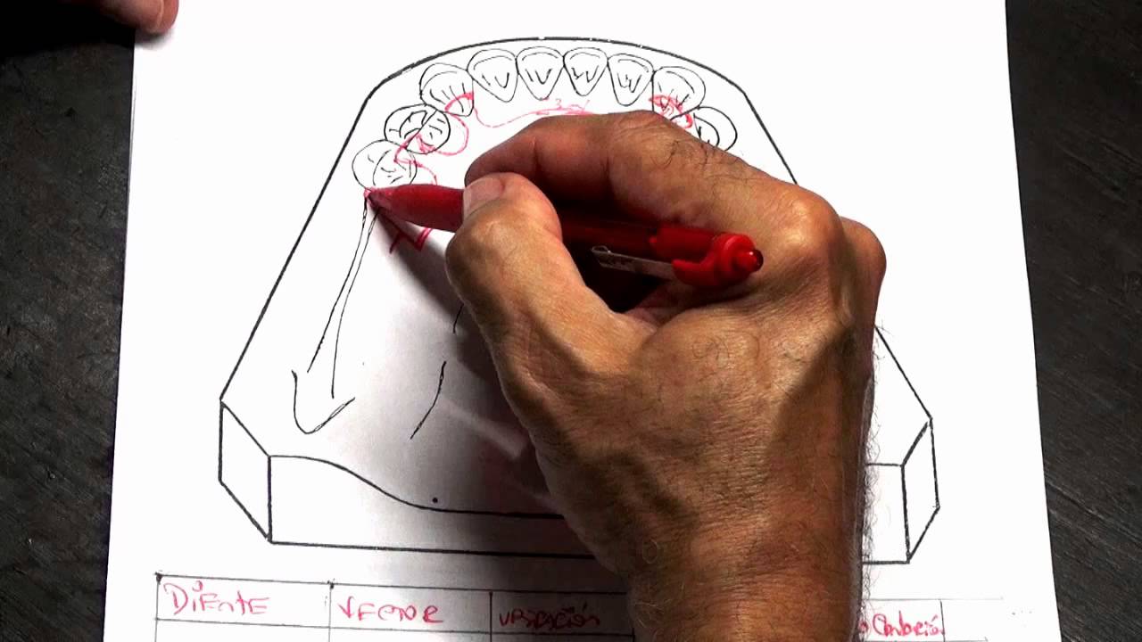 Diseño Parte I. Prótesis Parcial Removible, parámetros para diseño en clases I