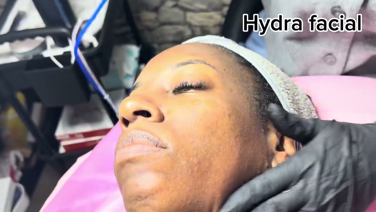 Full video of Derma planing and hydra facial