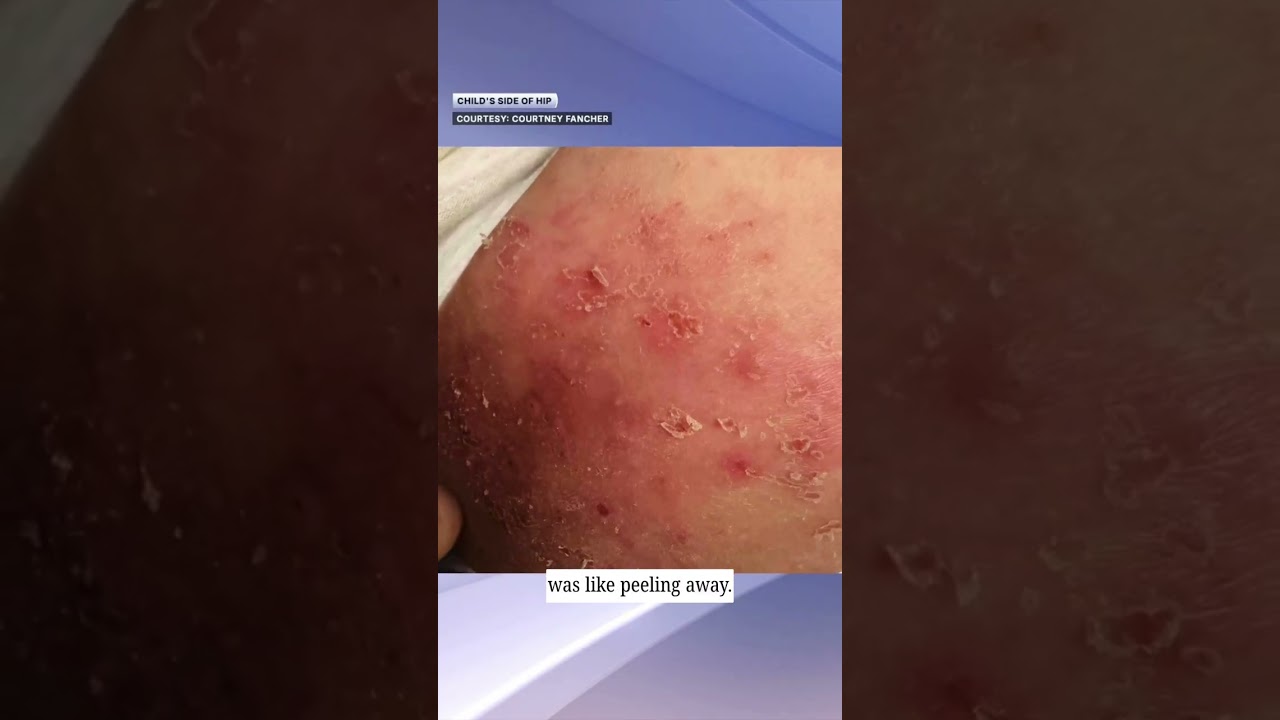 Millie Moon says it won&rsquo;t recall diapers, despite reports of chemical burns