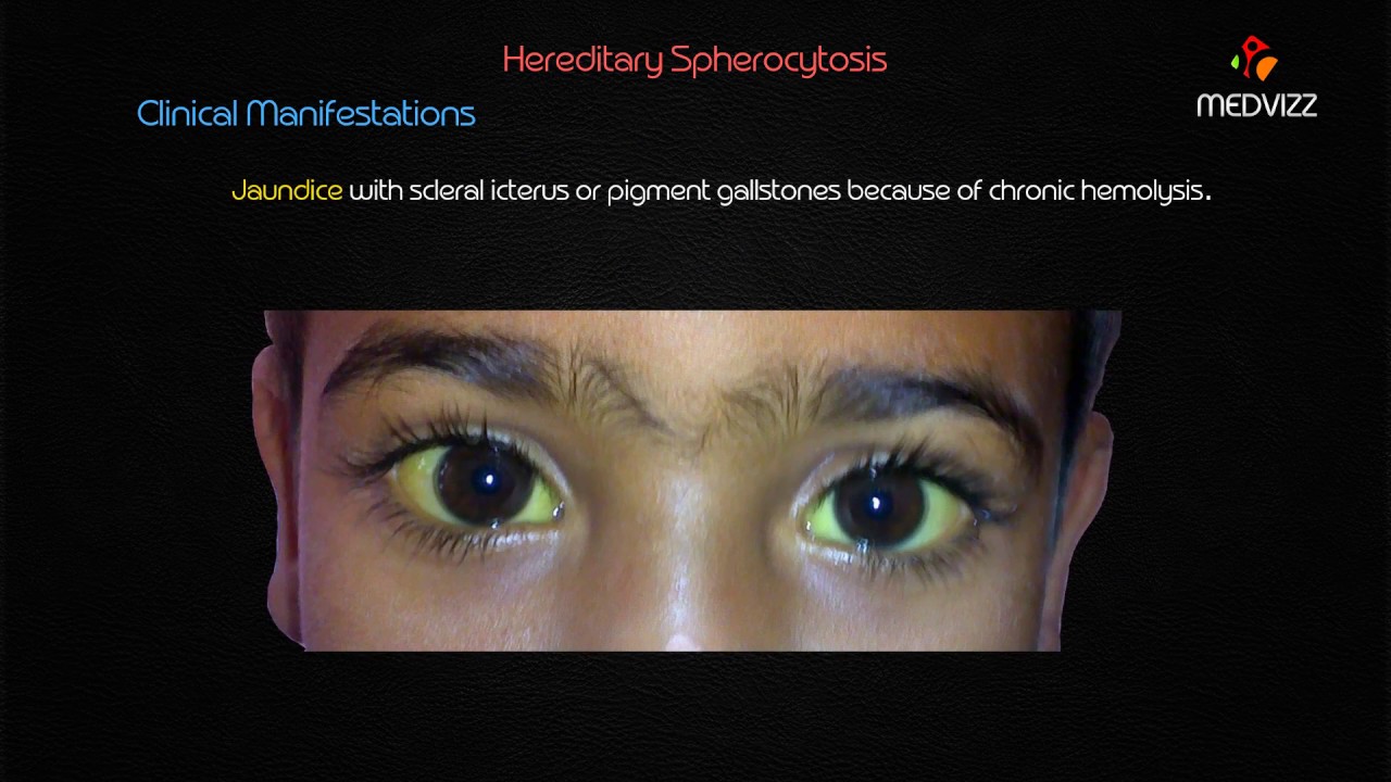 Hereditary Spherocytosis - Usmle case based Highyield lecture