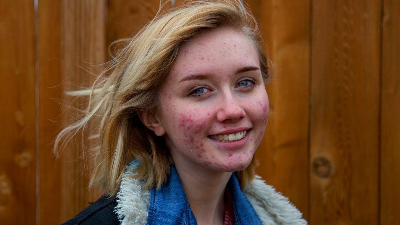 “Acne Doesn’t Make You Ugly