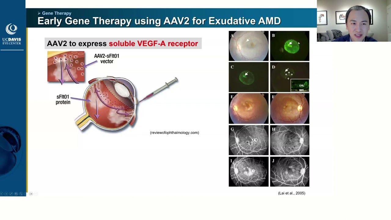 Lecture: Gene Therapy for AMD: Are We There Yet?