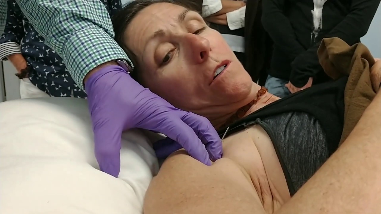 Orthopedic Trigger Point Acupuncture: Dry Needling & Chinese Medicine - Deltoid