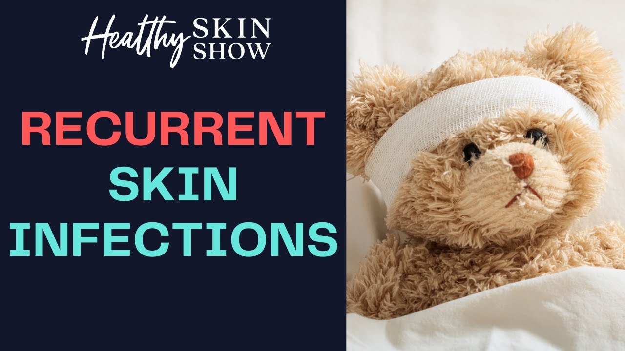 TOP Tips To STOP Recurring STAPH Skin Infections | Dr. Peter Lio