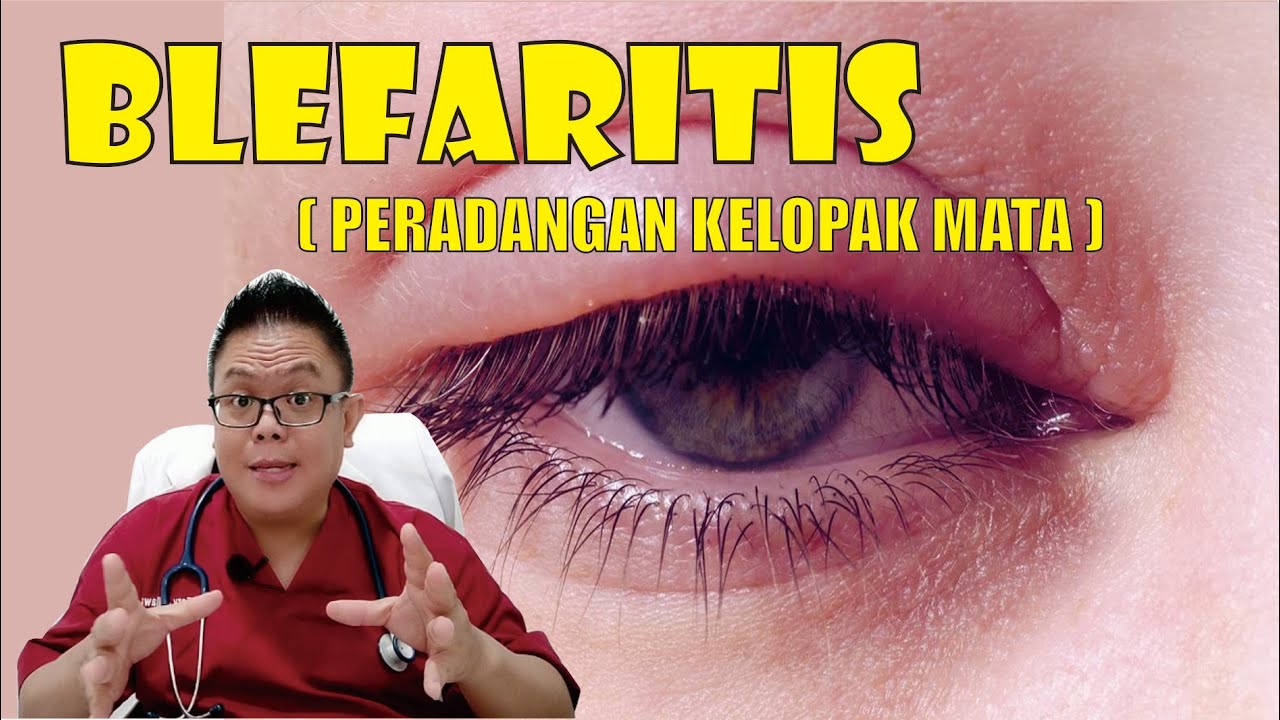 BLEFARITIS - DEFINISI, GEJALA, PENYEBAB, KOMPLIKASI & PENCEGAHAN
