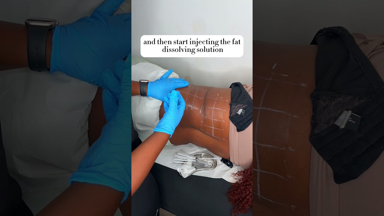 Fat Dissolving Injections | How It&rsquo;s Done | #FatDissolving | How To Reduce Stubborn Fat