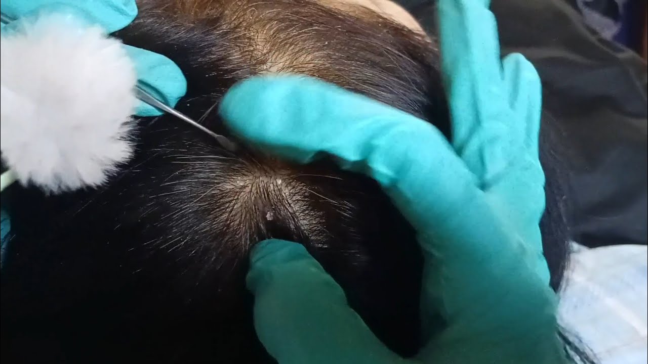 ASMR: Itchy Scalp Deep Clean