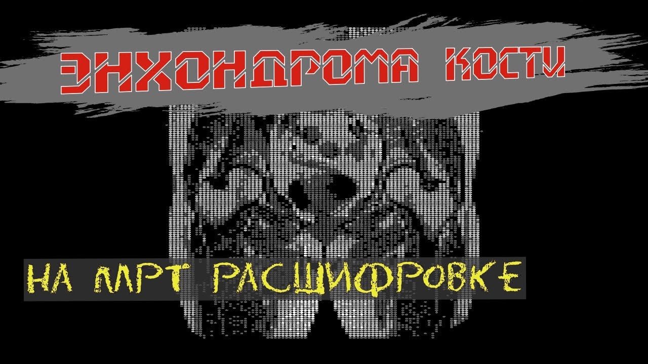ЭНХОНДРОМА подвздошной кости на расшифровке МРТ тазобедренных суставов.  ОСТЕОИД ОСТЕОМА кости.