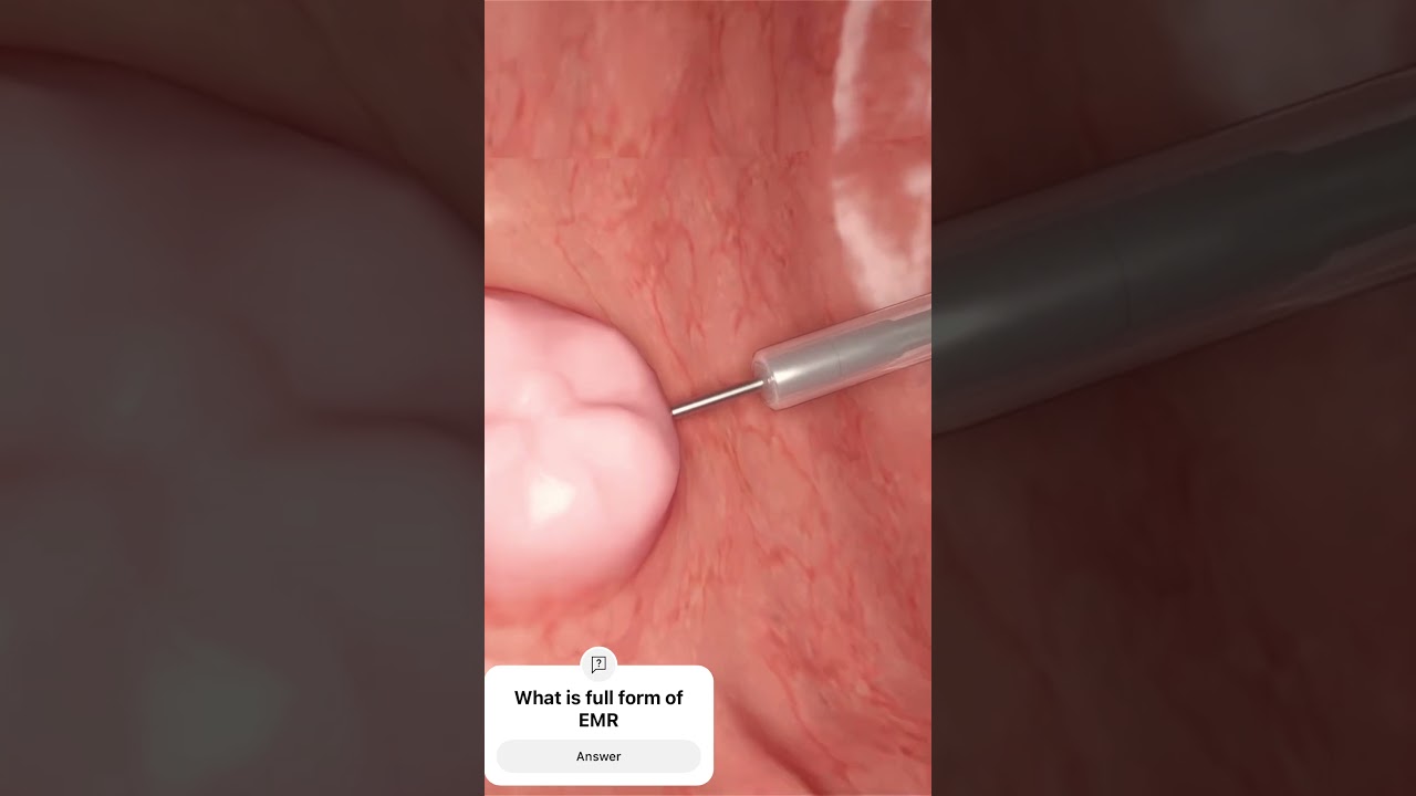 EMR, endoscopic mucosal resection for colonic polyp