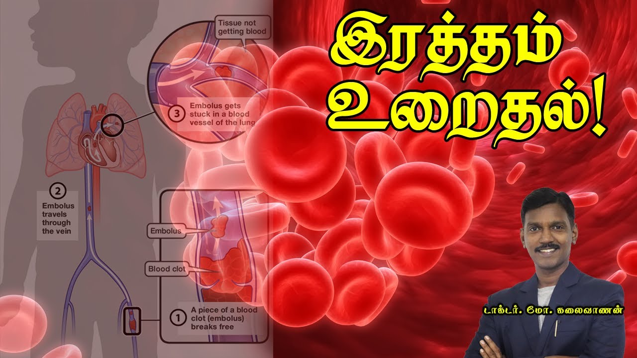 இரத்தம் உறைதல்...தடுப்பும்,தீர்வும்! | Blood Clots: Risks, Symptoms, Treatments, Prevention
