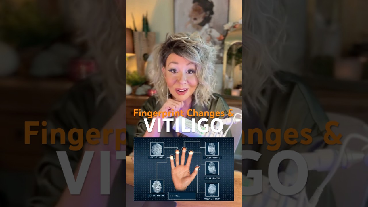 Fingerprints and Vitiligo