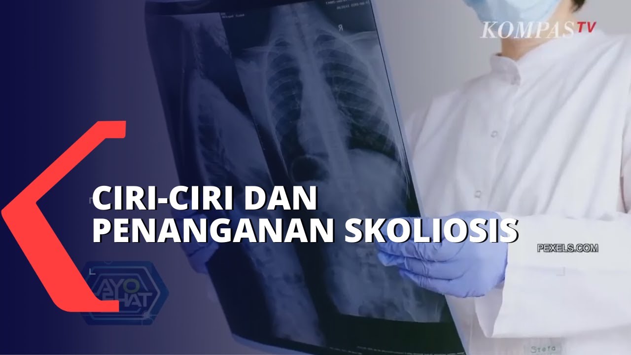 Begini Ciri-cirinya Bila Anda Menderita Skoliosis