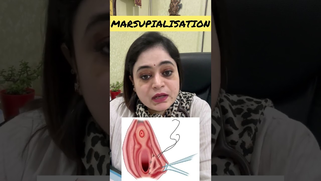 Bartholin cyst and abscess causes and treatment #gynecologist #vaginainfection #gynaec