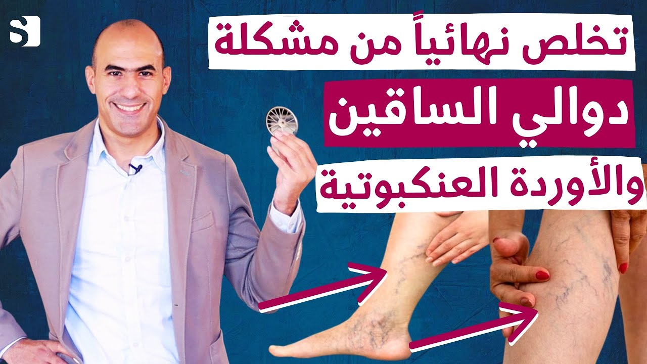 علاج دوالي الساقين والاوردة العنكبوتية نهائيا | تخلص من مشكلة الدوالي باسرع طريقة