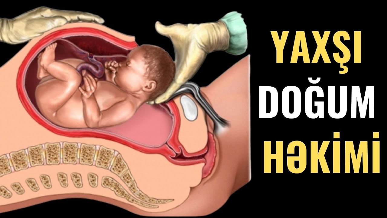 Doğuş vaxtı Cırıq, Qanaxma...- Həkimlər Nəyi Səhv Edir?