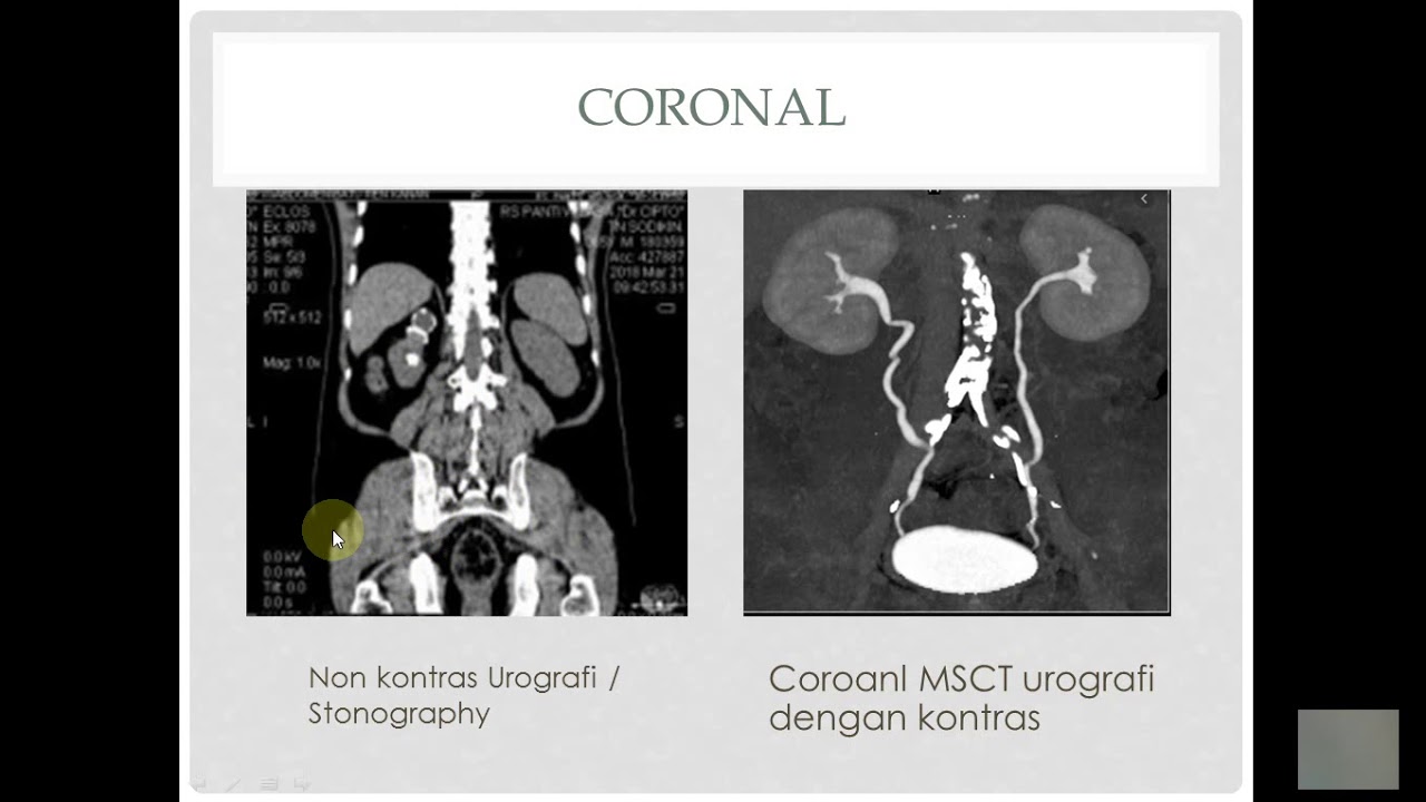 CT Scan Urografi, Urology, Stonograpy, Teknik Pemeriksaan