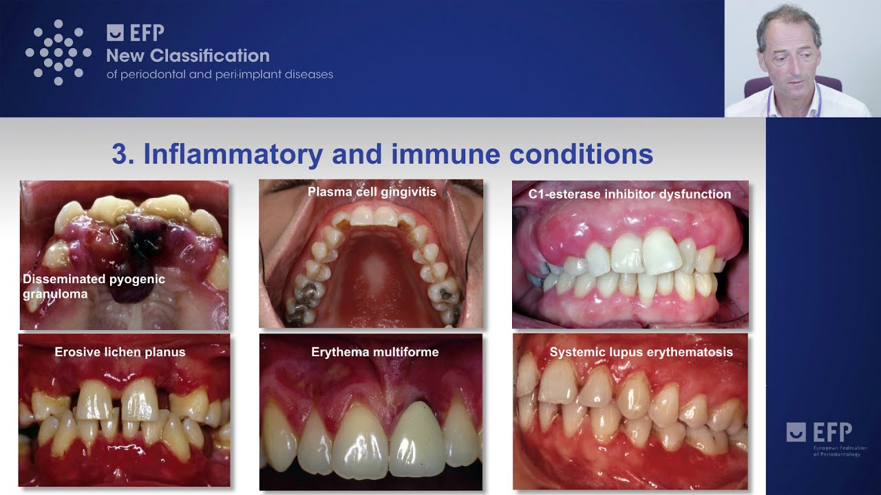 Non-plaque-induced gingival diseases - tutorial by Iain Chapple