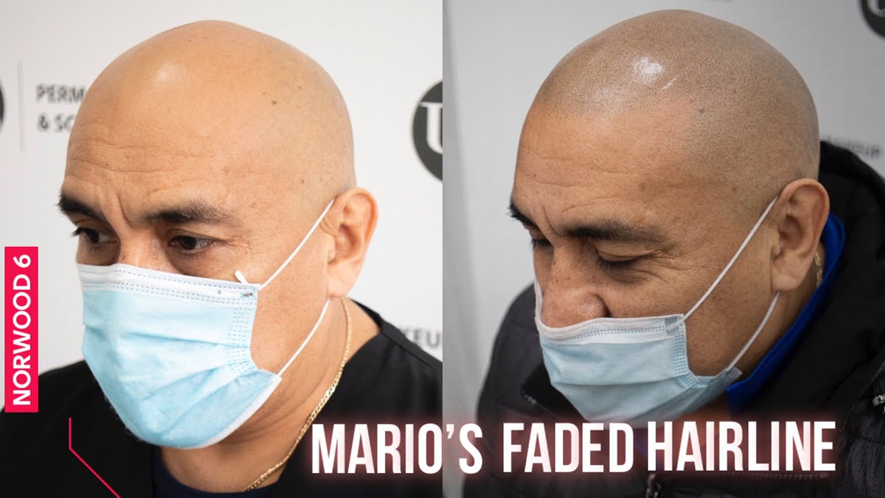 Mario’s Faded Hairline done using  Scalp Micropigmentation