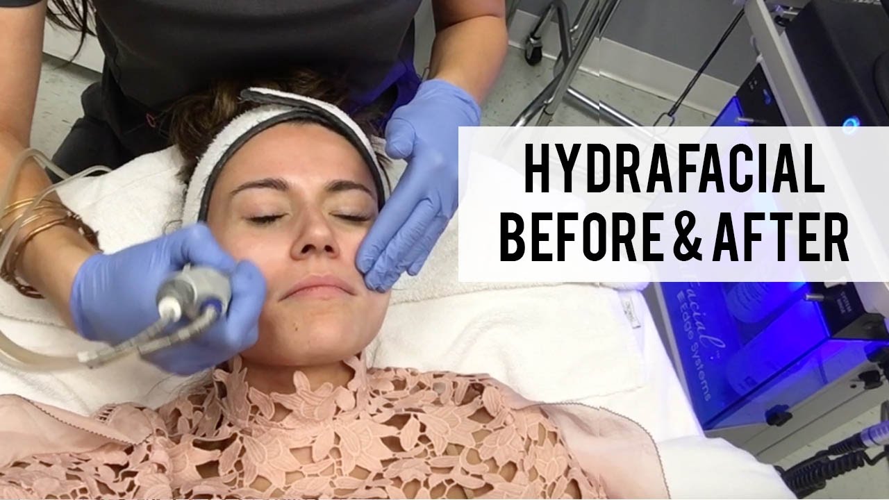 VLOG: Hydrafacial Before and After