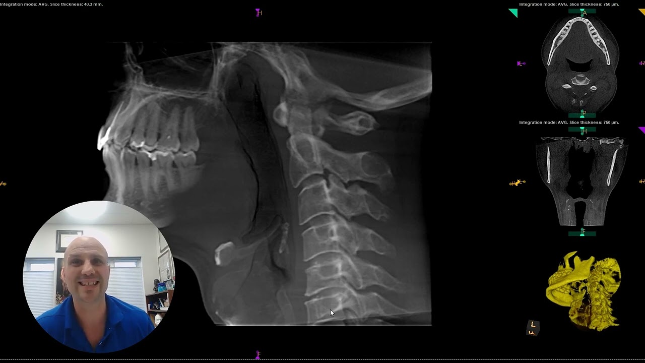 Life-Changing Results from Upper Cervical Care- Meniere's Disease and Brain Fog